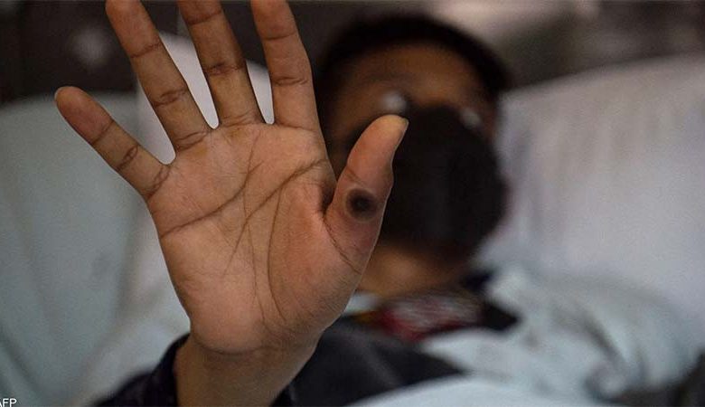 السودان يرصد 5 حالات أخرى لمرض جدري القرود